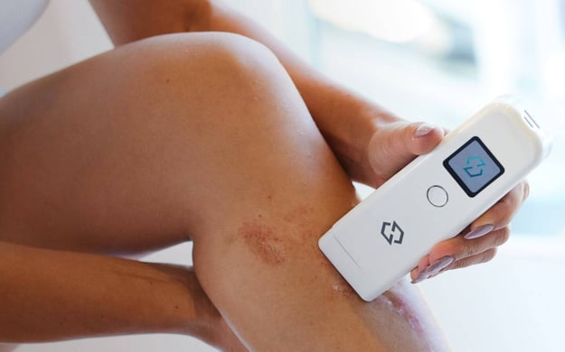treating-and-managing-eczema-at-home